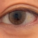 윤의원 | 애교살 필러 받은 후기/맑은윤의원 구의점