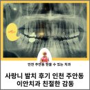 사랑니 발치 후기 인천 주안동 이안치과 친절한 감동