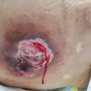 Debridement &amp; Dressing 이미지
