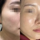 서울한스치과의원 | 얀의원 쥬베룩 스킨부스터, 블룸쥬베룩 솔직 후기