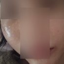 닥터에버스의원 목동 | 천안 리쥬란 후기, 닥터에버스의원에서 맞아본 솔직 기록