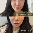 내돈내산 연세라미슈의원 쿨페이즈리프팅 후기
