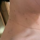 김형진베이직성형외과의원 | (결혼준비) 승모근 +넥슬림 주사 후기[김형진베이직성형외과/내돈내산]