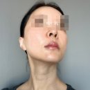 연신내피부과 써마지 셀리뉴 고주파 리프팅 통증 효과 찐후기