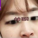 비씨아이성형외과의원 네이버블로그