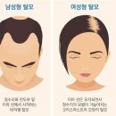 청담두피커버/강남두피커버 미우새 이동건 탈모치료?