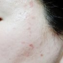 이종호 | 레이저로 점빼기 주의사항 한달후기 (이종호피부과)