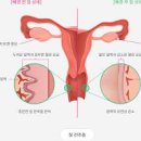 질건조증 증상 및 원인과 치료 : 영양제 이미지