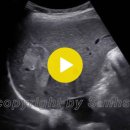 Hepatic hemangioma 52/F 간혈관종 이미지