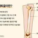 「실은 골다공증예방에 우유는 잘못？」건강한 뼈를 위해정말로 권하고 싶은 음식물 이미지