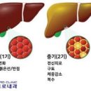 간경화 초기증상 치료 간 안좋을때 이미지