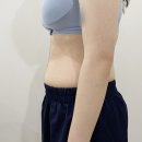 숨케어한의원 | 뱃살다이어트 2주차 후기, 지방분해약침 통증 가격 후기 (ft. 청담동 다이어트한의원)