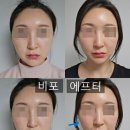 라클라쎄의원 | 강남역 티타늄 리프팅 효과 비포 에프터 확실한 비교 샷 보여드림