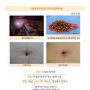 다발성담석증수술후기. 서울의 담낭 복강경 전문병원을 서너곳 물색하고 비교해본 결과 김정윤 원장님에게 신뢰가 가서... 이미지