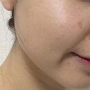 가재약국 | 부산 흑자제거 후기 1탄 (피부과 흑자 레이저 비용, 리팟레이저 아님)