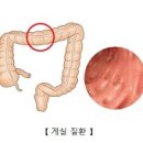 게실염 (Diverticular disease) 이미지