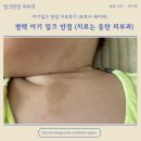 미소반점 | 평택 아기 밀크 반점 치료 동탄 밀크 반점 피부과 치료 후기