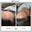 스킨모발팡팡 | 문신 4년 후 잔흔과 번짐 없을까? 강서구 SMP 리얼 후기 헤어라인문신4년후 4년지난헤어라인 오래된헤어...