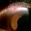 둔산중로-15 | 대전스마일라식후기, 바로 회복? 15년 렌즈 생활 종결