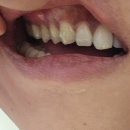 위치과의원 | 원주 단구동 치과명작치과의원 신경치료 후기 / 원주 치과 신경치료 후기