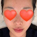 코리아엔제이 | 대구 동성로 에스테틱 제이라인코리아｜아프지 않은 울리푸 리프팅 관리 후기