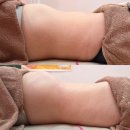 세기메디칼 | 울산 노진희 피부연구소 에서 리프팅 웨이브온다 복부 관리 3회차 다이어트 후기