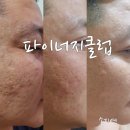 파이온텍 psi스킨임플란트 재생관리!!!비싼돈 들이지 않고도 피부의 모든고민해결