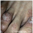 엔드와츠 사용법 후기 발사마귀 재발 어떻게 관리할까요?