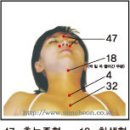 기침, 가래, 편도선염 등 감기 심천사혈요법 사례 이미지