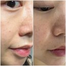 온더아셀 | 수원 피부과에서 쥬브아셀 스킨부스터 받고온 후기!