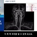 뇌혈관 및 경동맥 협착의 진단과 치료(21.11.4) 김준엽교수 이미지