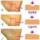 야뇨증, 오줌싸개 원인과 치료 이미지