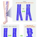 케이씨에스구미수흉부외과의원 | 22살 하지정맥류 수술 후기* (구미 수 흉부외과, 수술통증, 하지정맥류증상, 레이저시술, 압박스타킹...
