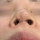 노즈랩의원 네이버블로그