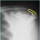 어깨 충돌 증후군(Impingement Syndrome) 이미지