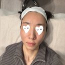 [리라젠부스터] 피부장벽 강화 시술 후기