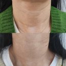 대구 목주름 리프팅 사진후기와 함께