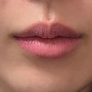 마이닥터의원 | 아름닥터 병원 / 강남라렌의원 / 팔자필러 + 입술필러 5개월차 후기 / 입술필러 환불