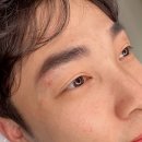 페리투에스테틱