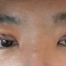 [1~7일차] 안검하수 수술 후기(남자 쌍커풀)