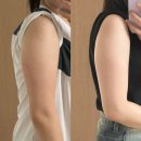 엔디어트의원 | 압구정다이어트 팔뚝 지방분해주사 엔드컷 위고비 1회차 후기