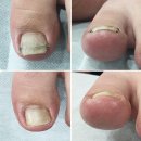 내성발톱 당일 시술 전후모습 비포애프터 케어ㅣ화성 발라발라네일 봉담점 이미지