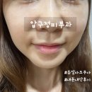 써클호텔 | 강남 압구정피부과 다크써클시술 듀얼다크주사 내돈내산 후기