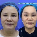 리프성형외과의원 | 리프성형외과 내시경이마거상술 효과 (수술 일지 19 - 눈매 개선 효과 후기)