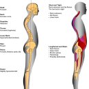 요추전만(Lordosis) 이미지