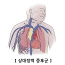 상대정맥 증후군[Superior vena cava Syndrome]순환기질환, 종양혈액질환, 호흡기질환 이미지
