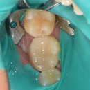 밝은치과의원 | 충치가 심한 충치치료 신경치료 안 하고 치료받고 싶은 영암 삼호 치과 삼호명인치과의원 치료받은 후기