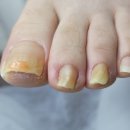 레푸스 감삼점&에이레네 | 대구 내성발톱 1:1 맞춤 체계적인 관리 후기