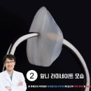 캘리포니아미형치과의원 | 앞니라미네이트 수명과 하나 파절시 가장큰 문제점은?