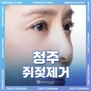 미와모의원 | 청주쥐젖제거 어디서 받는 것이 좋을까